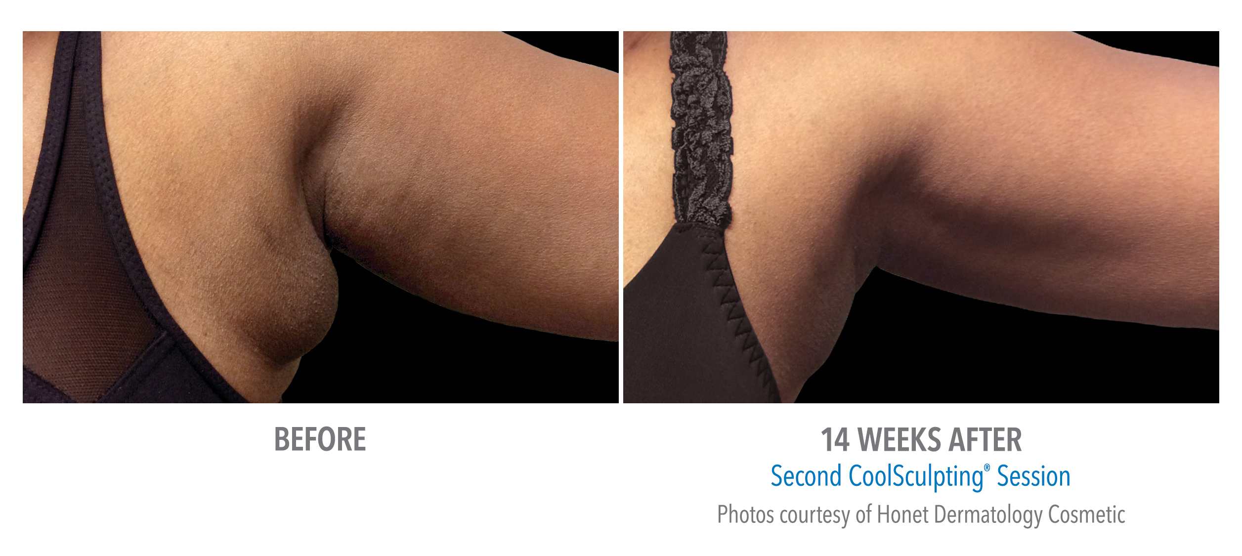 LiveYoung_CoolSculpting_BeforeAfter9