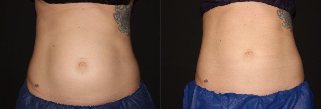 Coolsculpting Abdomen 3 month follow up