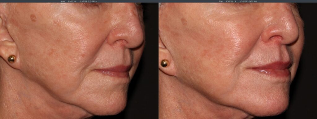 Woman with Dermal Filler