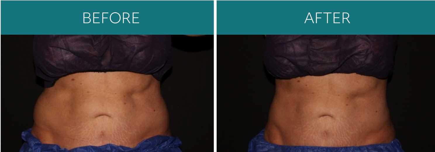 B&A_Coolsculpt_01