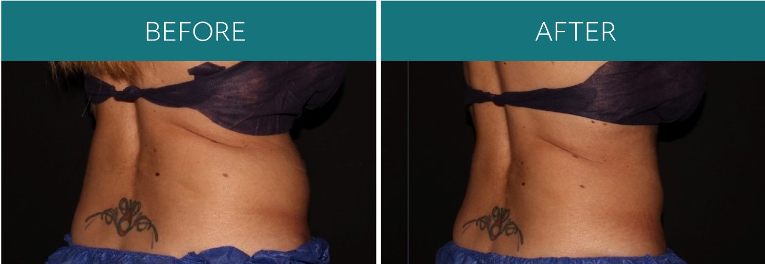 B&A_Coolsculpt_02