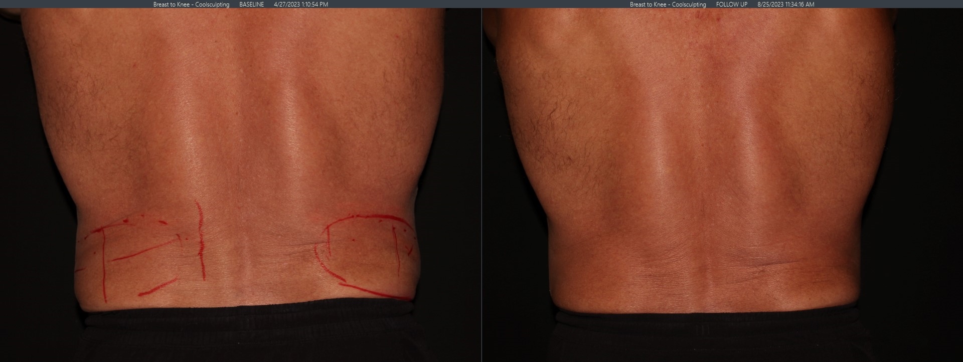 CoolSculpting B+A Male Flanks JPG